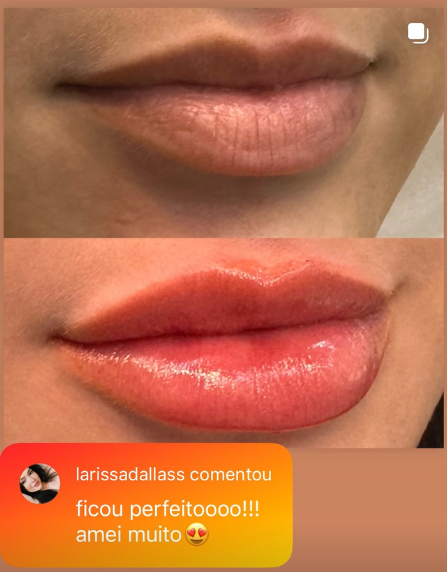 Antes e depois de preenchimento labial realizado pela Dra. Renata Hitomi